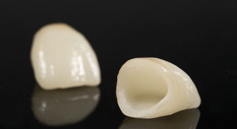 Zahnkronen und Zahnbrücken - Dr. med.dent. Thomas Schillinger - Zahnarzt Wien 1130