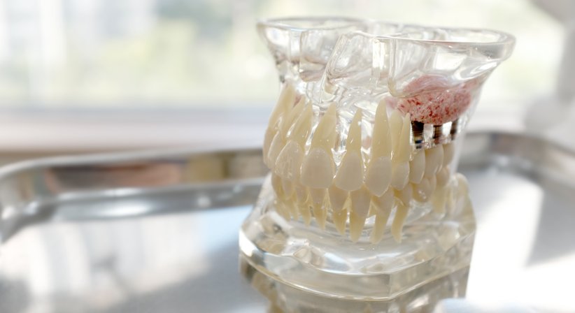 Knochenaufbau - Dr. Tobias Salfinger, MSc - Zahnarzt Roitham 4661