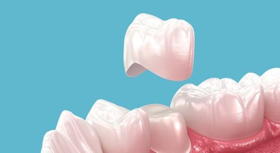 (Keramik-)Kronen, Brücken, Veneers