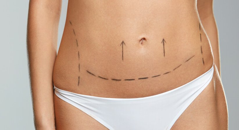 Bauchstraffung - Dr. Matthias Kolloros - Plastischer Chirurg Judenburg 8750