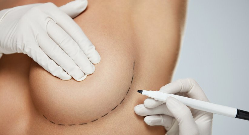 Brustvergrößerung - Dr. Matthias Kolloros - Plastischer Chirurg Judenburg 8750