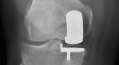 Knieendoprothese / KTEP bzw. medialer Halbschlitten