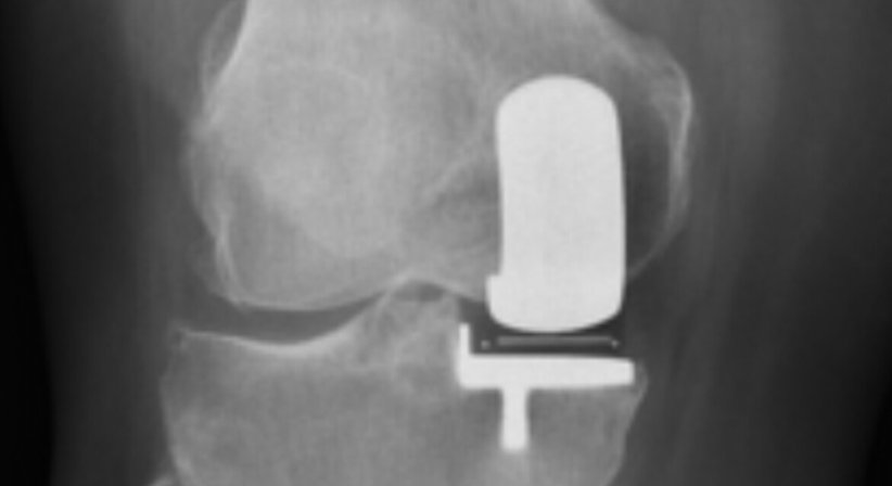 Knieendoprothese / KTEP bzw. medialer Halbschlitten - Dr. med. univ. Manuel Steiger, FEBOT - Orthopäde Parndorf 7111