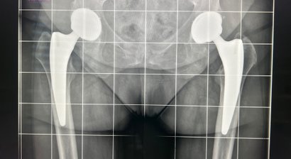 Hüftendoprothetik / HTEP