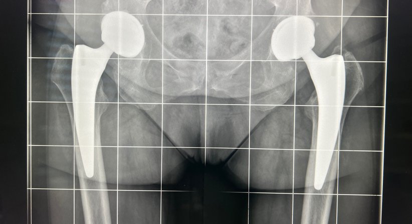 Hüftendoprothetik / HTEP - Dr. med. univ. Manuel Steiger, FEBOT - Orthopäde Parndorf 7111