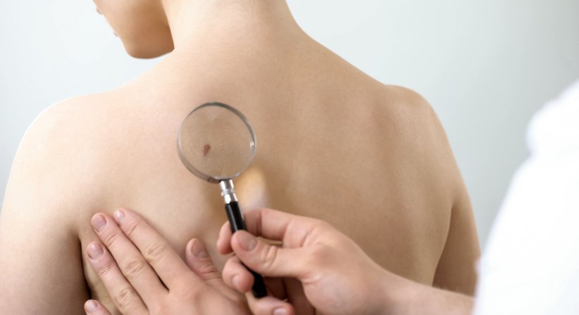 Hauttumore - Dr. Rudolf Woisetschläger - Allgemeinchirurg Linz 4020