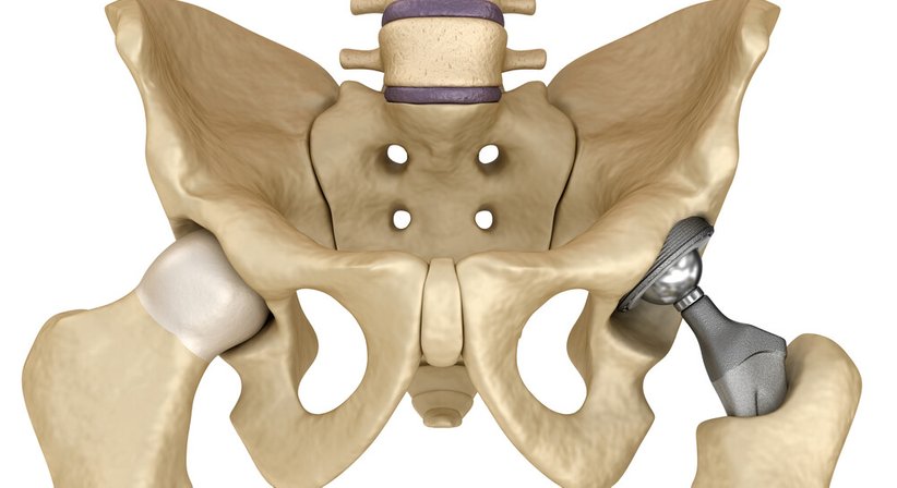 Hüftprothese - Dr. Johannes Bonomo - Orthopäde Wien 1160