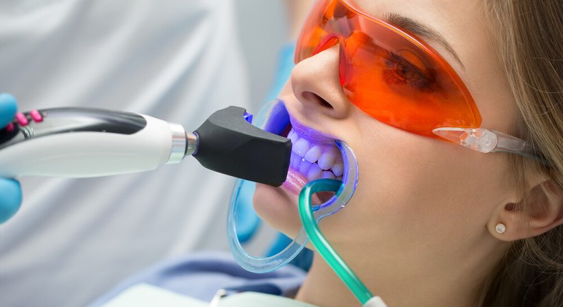 Bleaching - Dr. Gerhard Zips - Zahnarzt Wien 1150