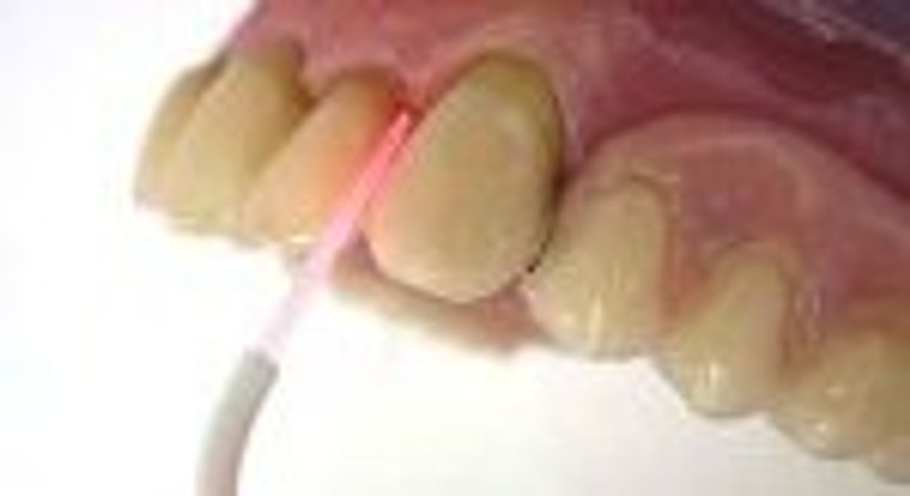 Softlaser - Dr. Gerhard Zips - Zahnarzt Wien 1150