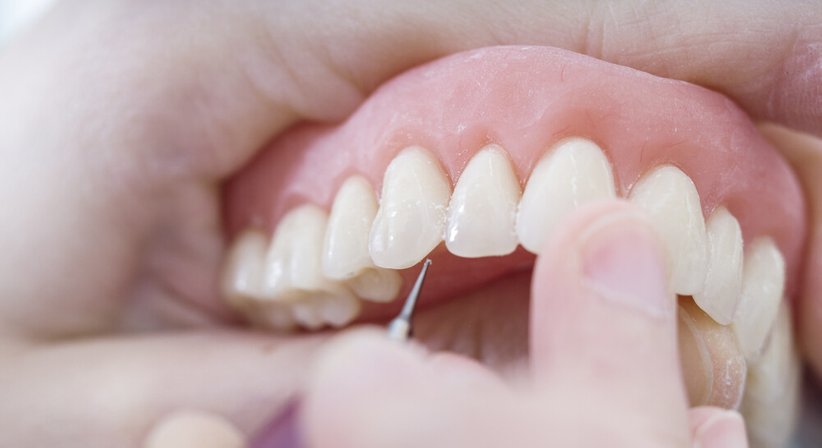 Teil- und Vollprothesen - Dr. Gerhard Zips - Zahnarzt Wien 1150