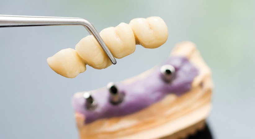 Kronen- und Brückenversorgung - DDr. Andreas Pinter - Zahnarzt Wien 1180