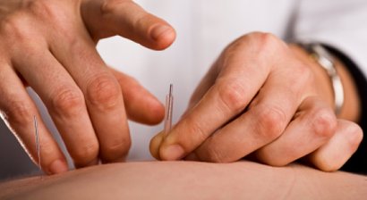 Akupunktur
