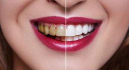 Bleaching -