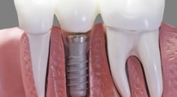 Implantate -