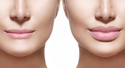Lippenfiller (Volumenaufbau)