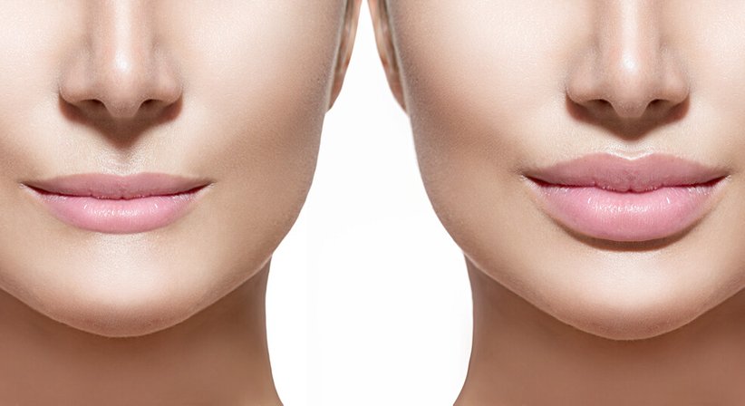 Lippenfiller (Volumenaufbau) - Priv. Doz. Dr. med. Nikolaus Duschek, PhD - Hautarzt Wien 1190