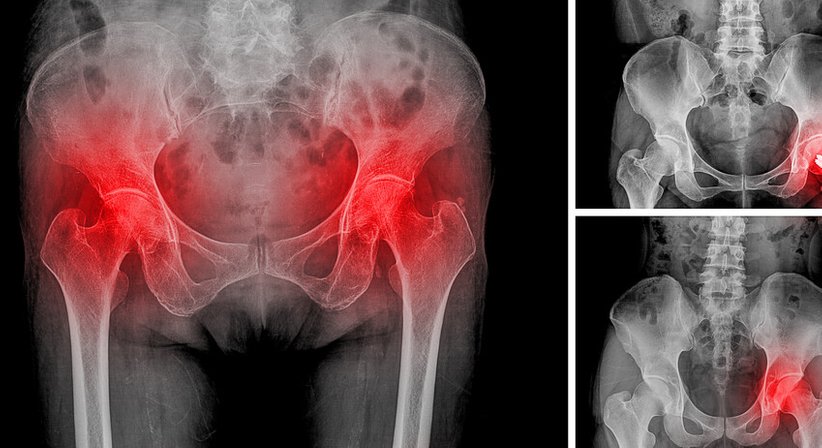Hüfte - Dr. Norbert Keiblinger - Unfallchirurg Linz 4020