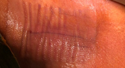 Narben und Herzschrittmachern Tasche Kosmetische Korrektur