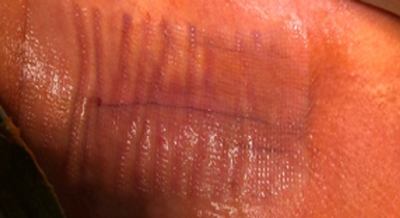 Narben und Herzschrittmachern Tasche Kosmetische Korrektur - Dr. med. univ. Cesar Khazen Vielma - Herzchirurg Wien 1010