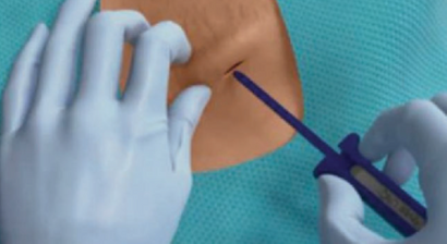  Implantation von MRI Ereignis-Recordern (Loop Recorders)