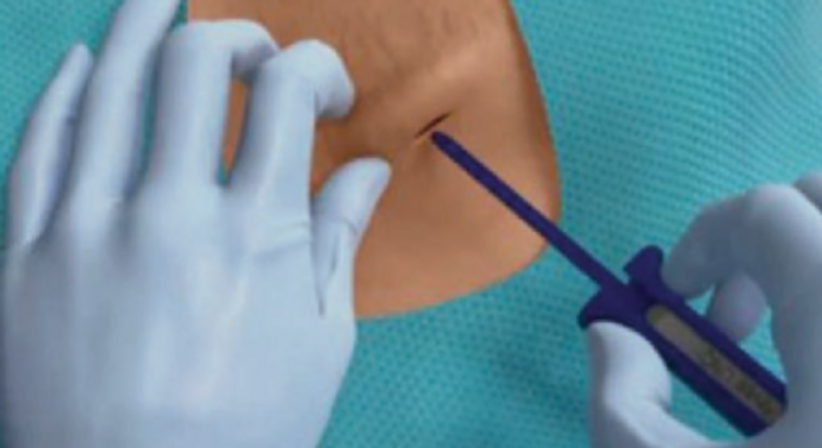  Implantation von MRI Ereignis-Recordern (Loop Recorders) - Dr. med. univ. Cesar Khazen Vielma - Herzchirurg Wien 1010