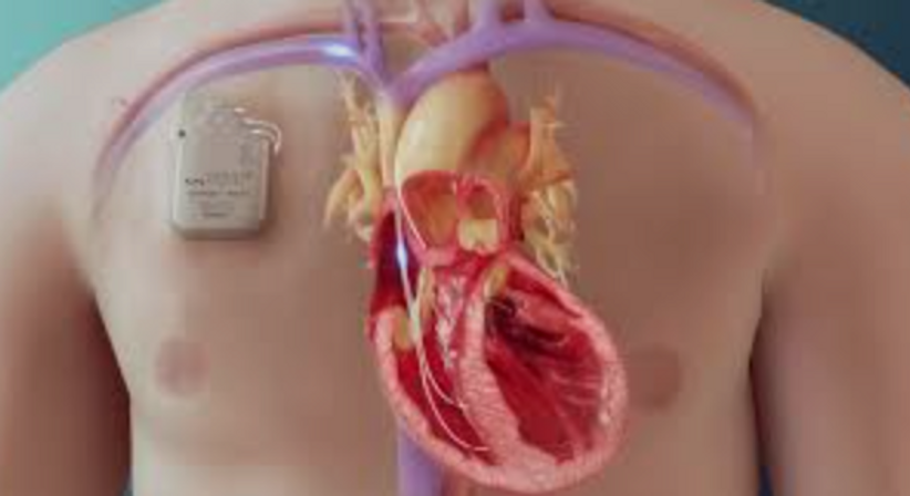 Implantation von Geräten zur Behandlung der Herzmuskelschwäche - Dr. med. univ. Cesar Khazen Vielma - Herzchirurg Wien 1010