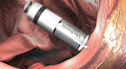 Kabelos Schrittmacher