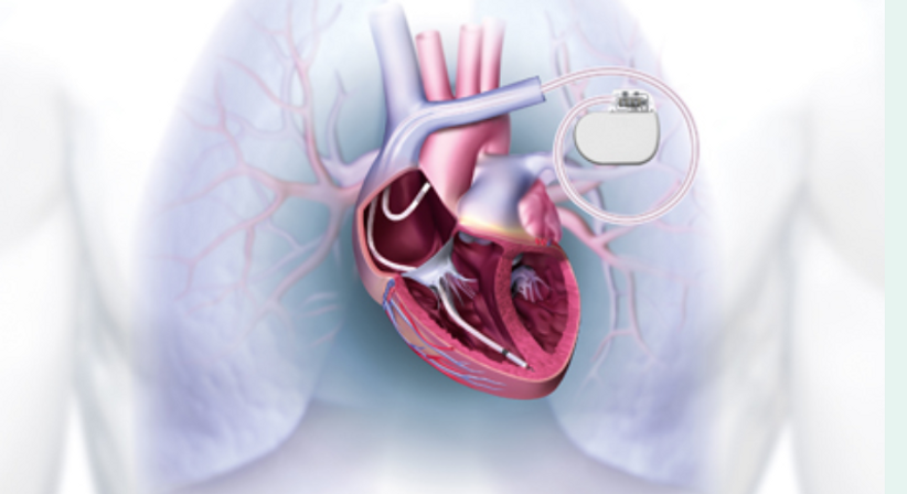 Implantation von Geräten zur Behandlung der Herzmuskelschwäche - Dr. med. univ. Cesar Khazen Vielma - Herzchirurg Wien 1010