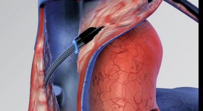 Entfernung von Schrittmacher und Defi Elektroden mittels LASER