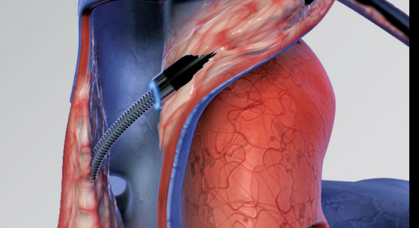 Entfernung von Schrittmacher und Defi Elektroden mittels LASER - Dr. med. univ. Cesar Khazen Vielma - Herzchirurg Wien 1010