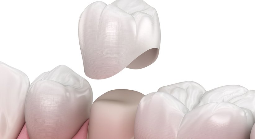 Zahnkronen, Zahnfüllungen und Wurzelbehandlungen - Spezialambulanz Parodontologie - Standort Simmering -  Wien 1110