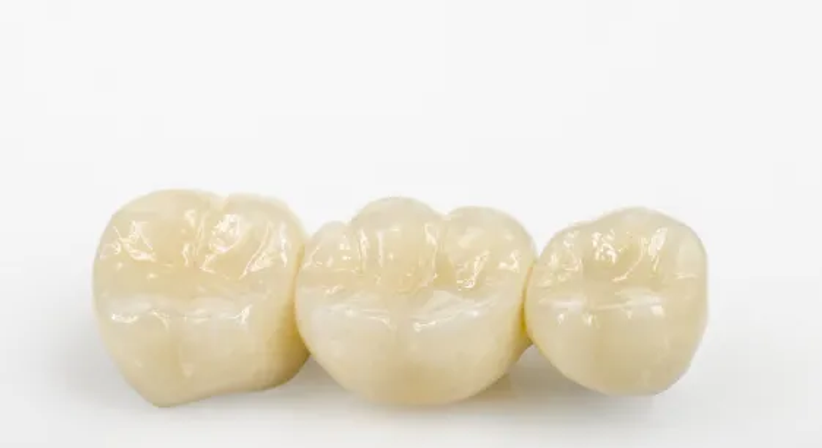 Veneers / Kronen / Brücken - Dr.med.dent. Natascha Witzmann - Zahnärztin Wien 1020