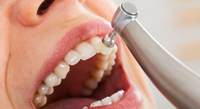 Professionelle Mundhygiene - Dr. Daniela Crupinschi - Zahnarzt Wien 1060