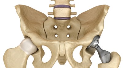 Hüft- und Knieendoprothetik (Einsatz eines künstlichen Gelenks)