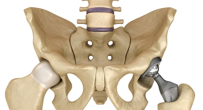 Hüft- und Knieendoprothetik (Einsatz eines künstlichen Gelenks) - OA Dr. Gerhard Klein - Orthopäde Wien 1080