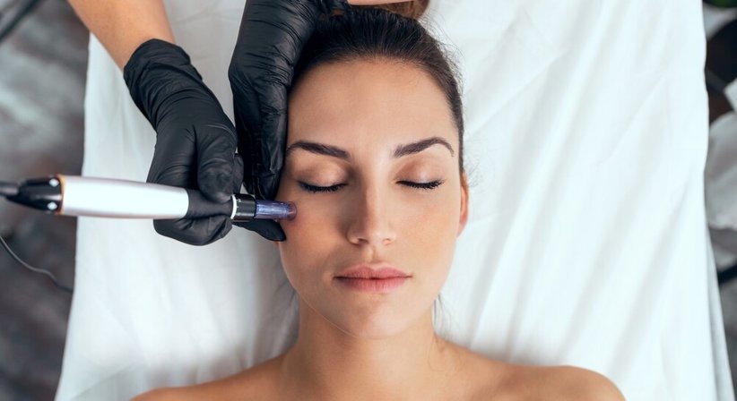 Microneedling mit Radiofrequenz (RF-Needling) - Dr. Klaus Toblier - Hautarzt Baden 2500