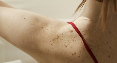 Muttermalkontrolle und Hautkrebsvorsorge