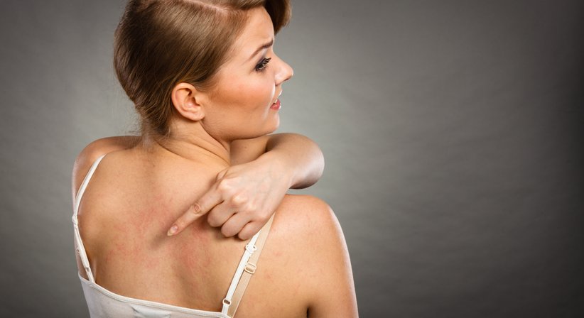 Urtikaria (Nesselsucht) - Dr. Klaus Toblier - Hautarzt Baden 2500