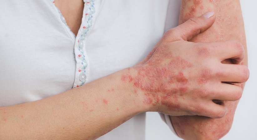 Psoriasis (Schuppenflechte) - Dr. Klaus Toblier - Hautarzt Baden 2500