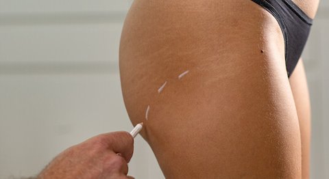 Priv.-Doz. Dr. Stefan Hacker, FEBOPRAS - Plastischer Chirurg Wien 1080
