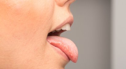 Speicheldrüsenentzündung (Sialadenitis)