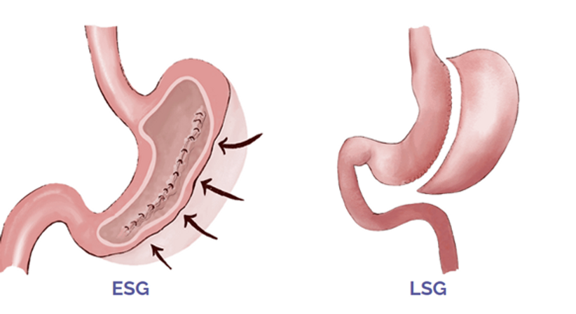 ESG - Endokopischer Schlauchmagen - Dr. Rudolf Johannes Stadlhuber - Allgemeinchirurg Salzburg 5020