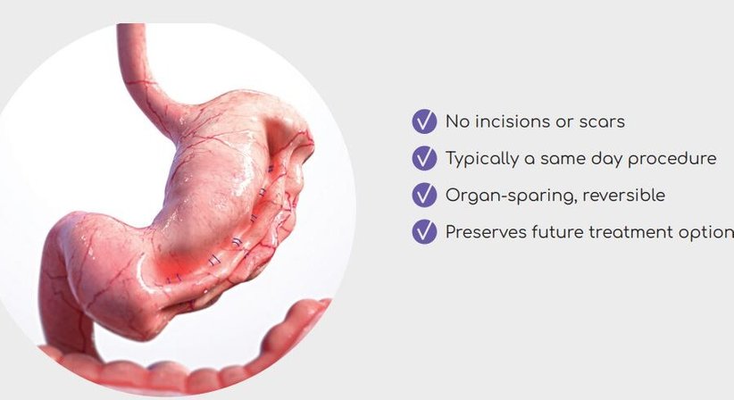 ESG - Endokopischer Schlauchmagen - Dr. Rudolf Johannes Stadlhuber - Allgemeinchirurg Salzburg 5020