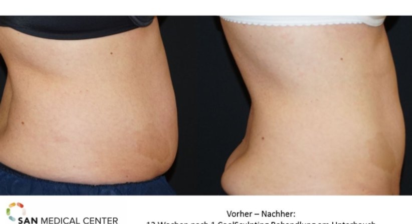 CoolSculpting - Fett-Weg-Frieren - Dr. Rudolf Johannes Stadlhuber - Allgemeinchirurg Salzburg 5020