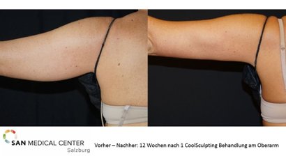 CoolSculpting - Fett-Weg-Frieren