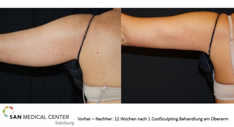 CoolSculpting - Fett-Weg-Frieren - Dr. Rudolf Johannes Stadlhuber - Allgemeinchirurg Salzburg 5020