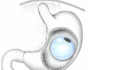 Magenballon - sanfte Gewichtsreduktion