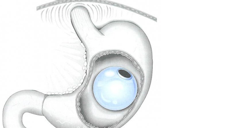 Magenballon - sanfte Gewichtsreduktion - Dr. Rudolf Johannes Stadlhuber - Allgemeinchirurg Salzburg 5020