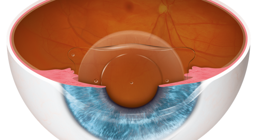Linsenimplantation (ICL) - Priv.-Doz. DDr. Gernot Steinwender - Augenarzt Graz 8010
