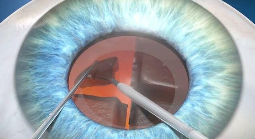 Operation des Grauen Stars (Katarakt) - Priv.-Doz. DDr. Gernot Steinwender - Augenarzt Graz 8010